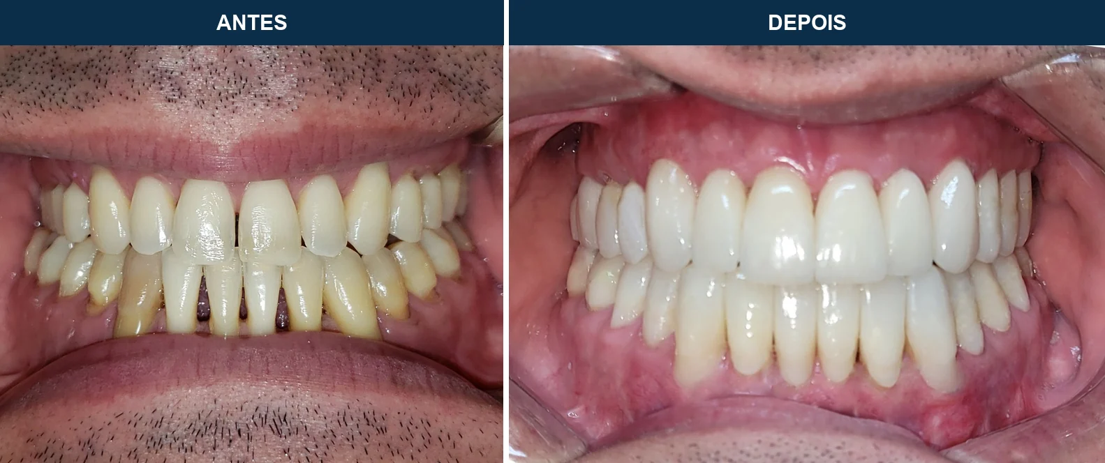 Coroas de Porcelana - antes e depois