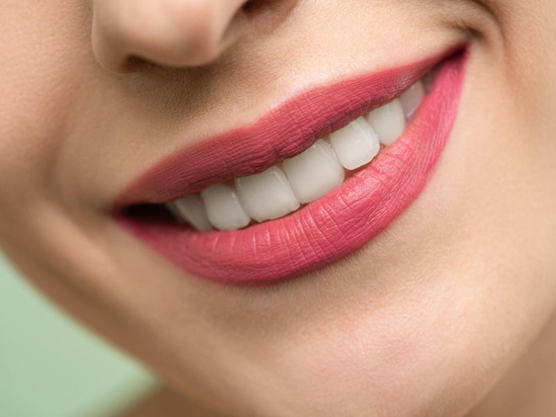 Sorriso Gengival