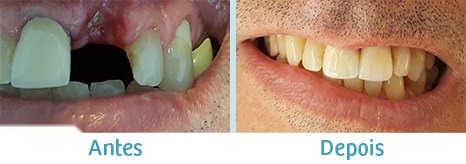 Implante dentário - antes e depois (caso clínico Odontossistêmica)