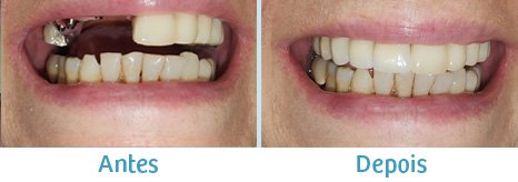 Reabilitação com implantes - antes e depois (caso clínico Odontossistêmica)
