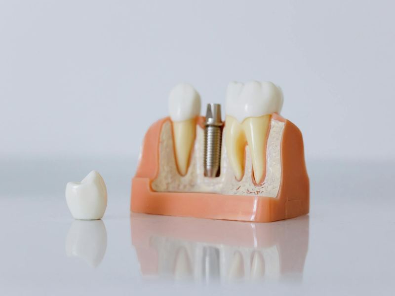 Implantes Dentários