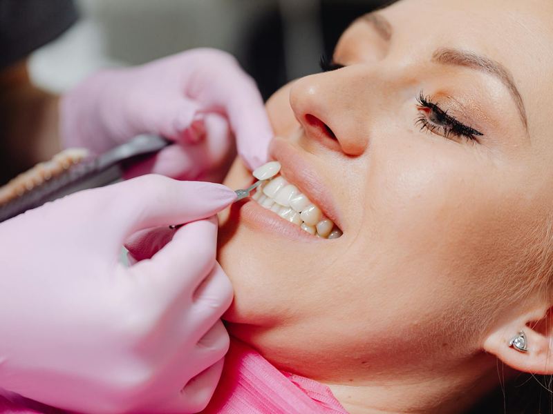 Lentes de Contato Dental