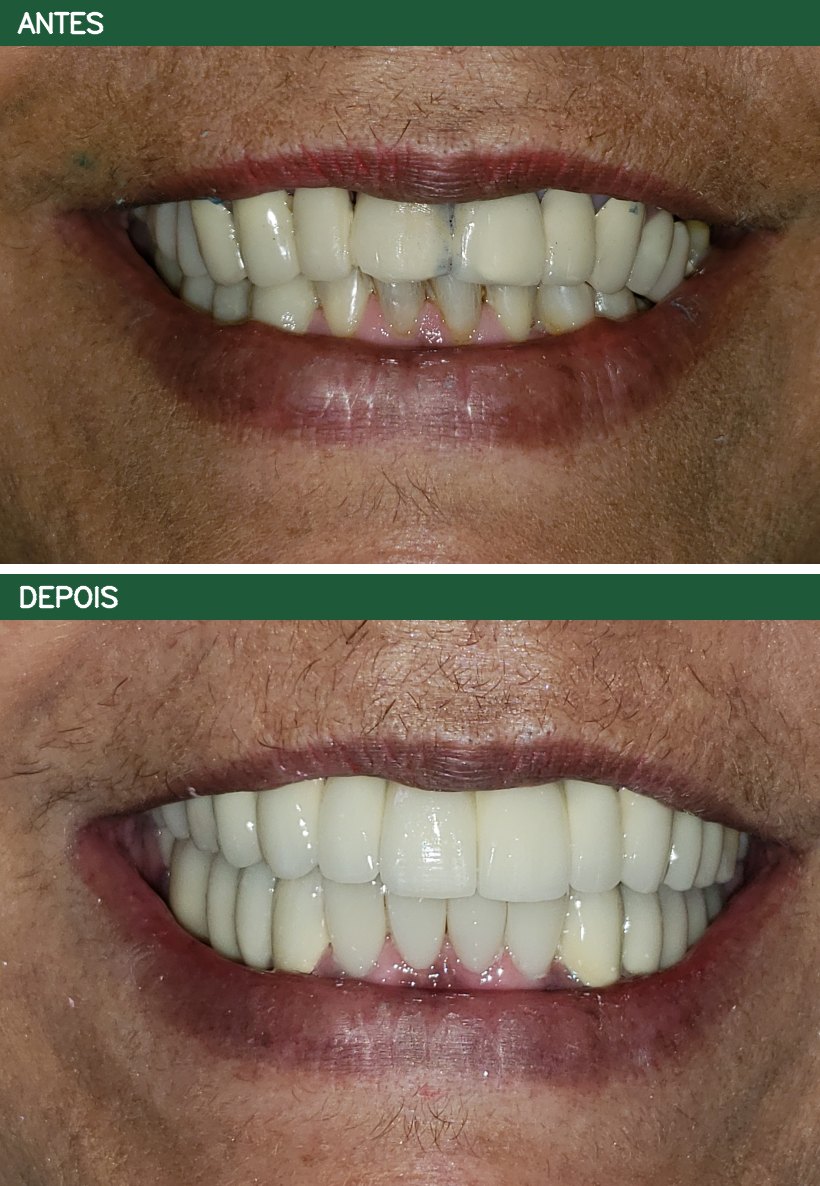 Reabilitação Oral - antes e depois
